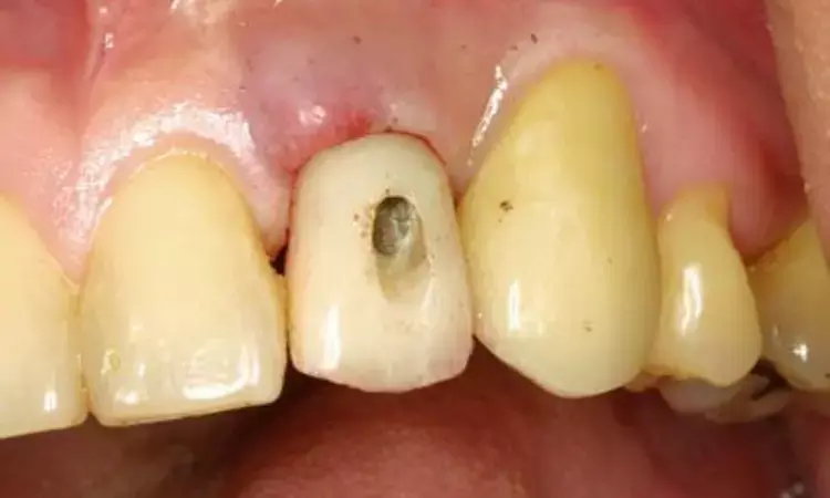 Screw-retained dental restorations fail to prevent peri-implantitis versus cement-retained implant-supported prostheses