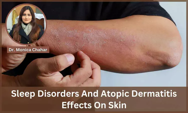 What is the Unholy Link of Sleep Disorders and Atopic Dermatitis on Skin? -  Dr Monica Chahar
