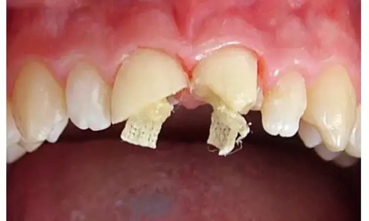 Compared to metal posts, prefabricated carbon and glass fiber posts may reduce risk of tooth fracture in endodontically treated teeth