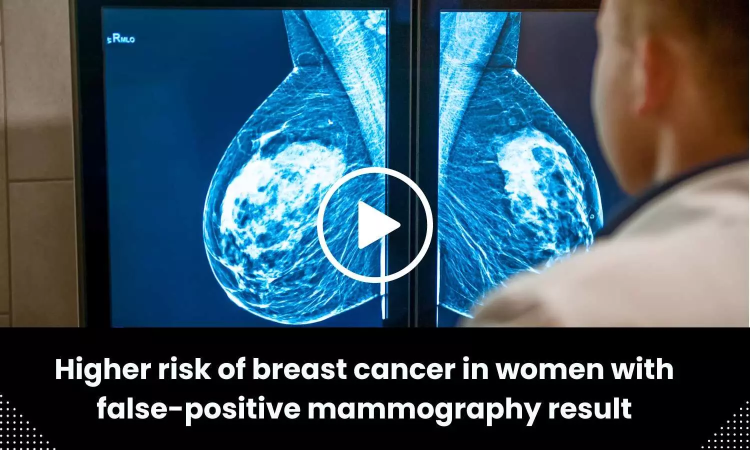 Higher risk of breast cancer in women with false-positive mammography result