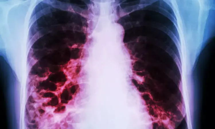 ICS use does not further increase the hospitalization risk of pneumonia among patients of concomitant Bronchiectasis and COPD