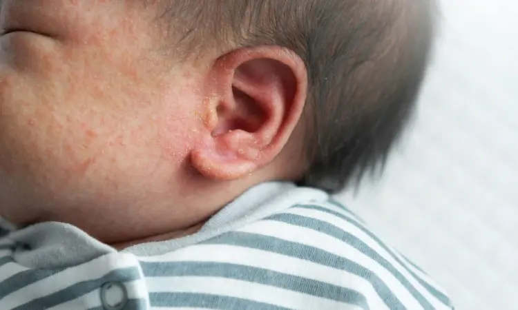 Low Risk of Severe Infections Observed in Afebrile Infants with Pustules: Study
