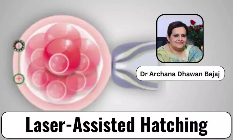 How Laser-Assisted Hatching is Changing the IVF Landscape? - Dr Archana Dhawan Bajaj