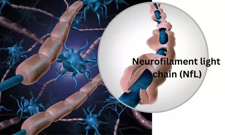 Blood neurofilament light chain level early diagnostic marker for Multiple Sclerosis: JAMA