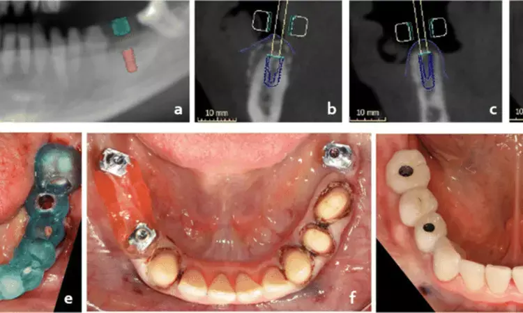 Robotic computer-assisted implant surgery promising for placing dental implants in fully edentulous patients