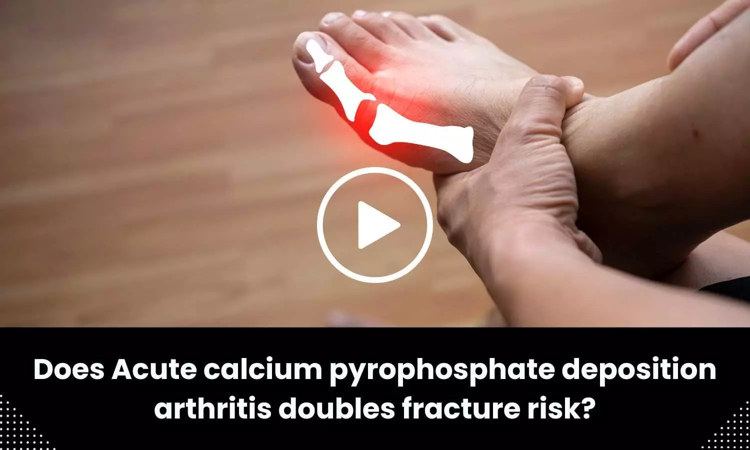Does Acute calcium pyrophosphate deposition arthritis doubles fracture risk?