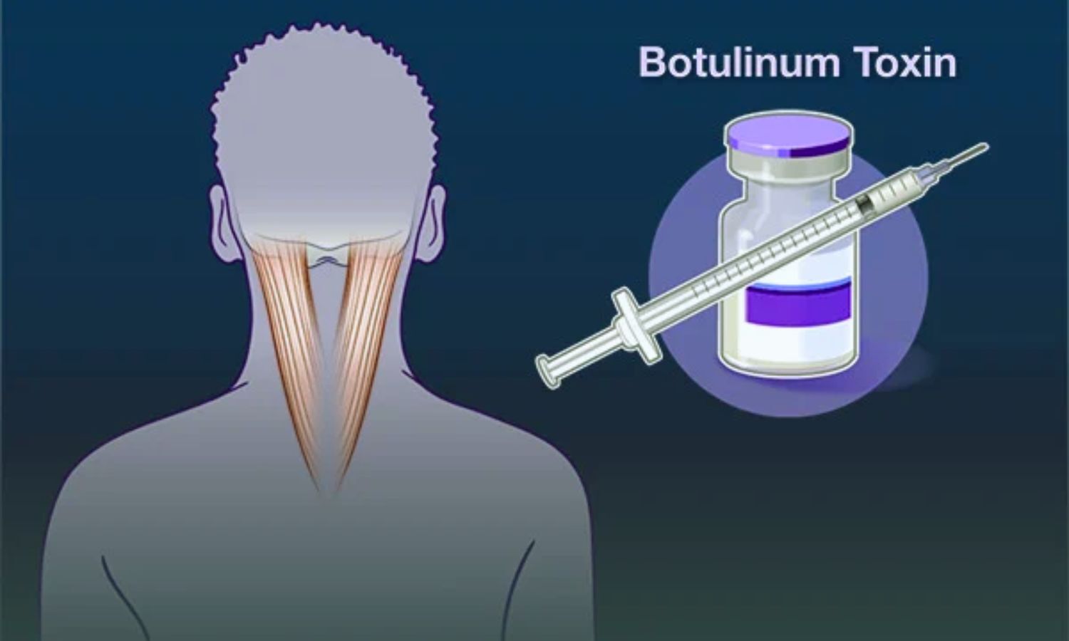 Botulinum Toxin Shows Promise for Treating Raynaud's Phenomenon in ...