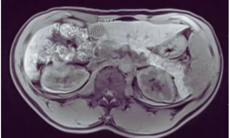 Algorithm based on MRI features can predict liver cancer recurrence after resection