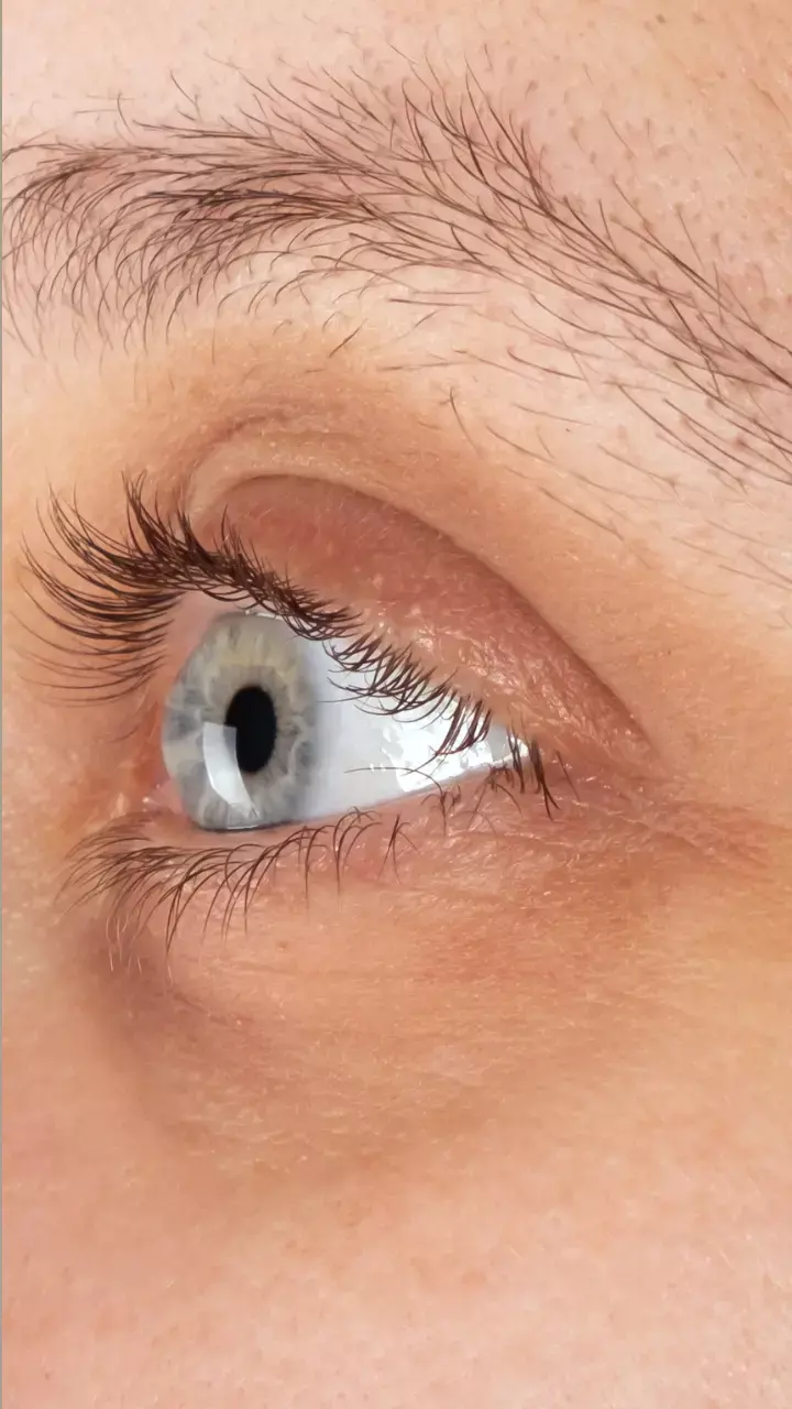 World Keratoconus Day 2023