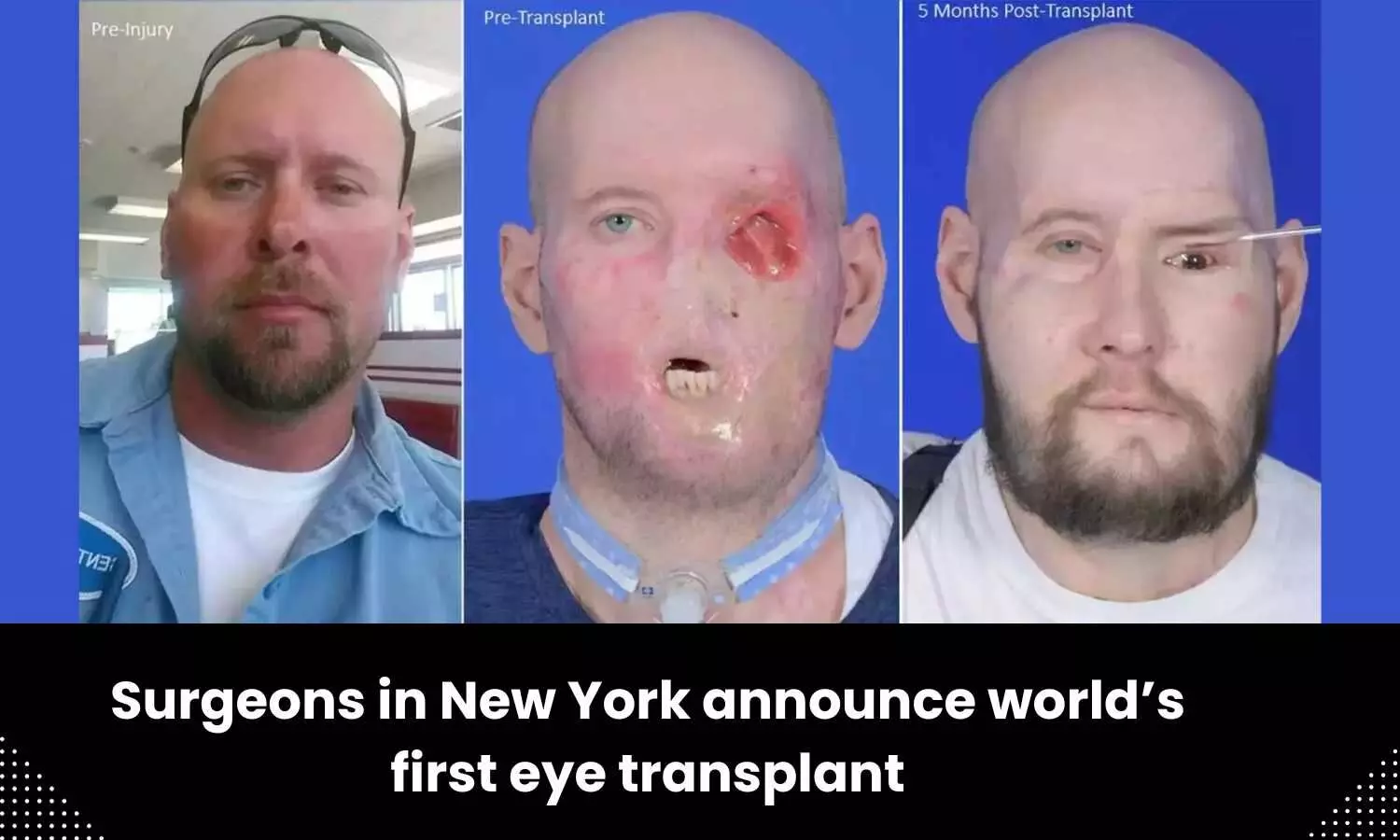 New York surgeons performs first-ever whole-eye transplant in human