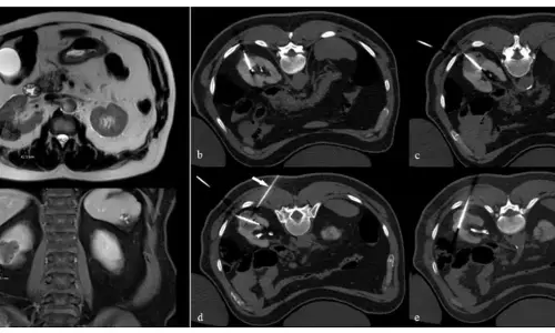 Chest CT scans offer critical insights into the lung function of sarcoidosis patients,  reveals research Chest CT scans offer critical insights into the lung function of sarcoidosis patients,  reveals research