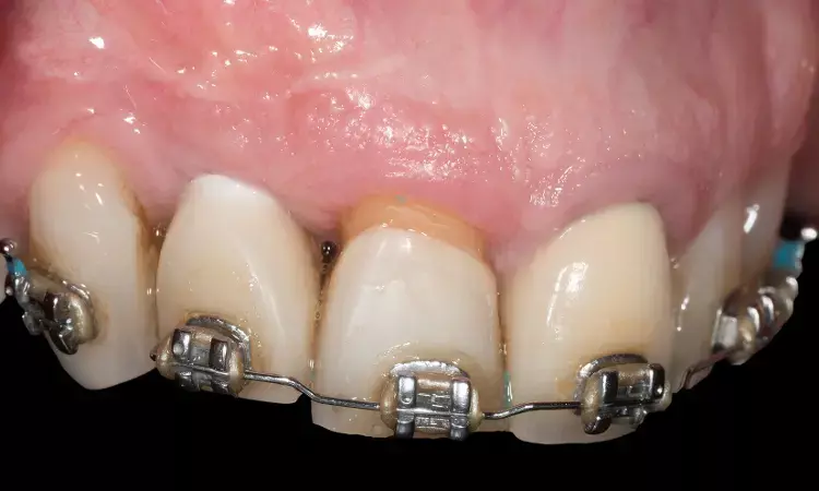 Orthodontic extrusion useful option to regenerate dento-implant papilla defect