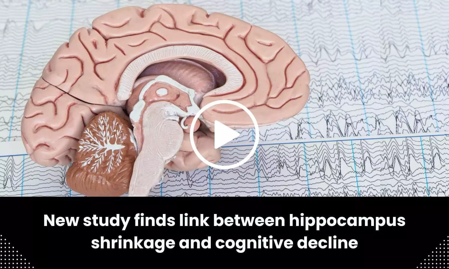 New study finds link between hippocampus shrinkage and cognitive decline
