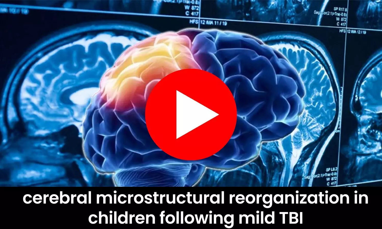 Cerebral microstructural reorganization in children following mild TBI