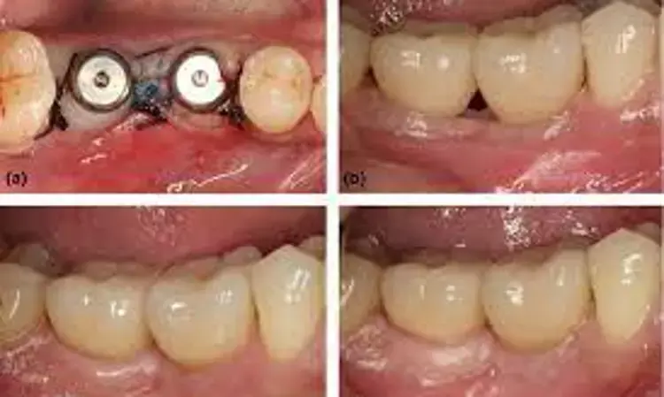 Platform switching of dental implants useful approach for retaining crestal bone around dental implants