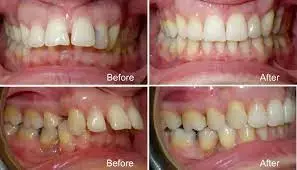 Planned overbite reduction challenging in patients with extractions following treatment with Invisalign aligner appliances