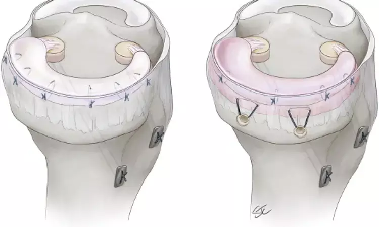 Meniscal allograft transplantation improves patient reported outcomes in moderate knee osteoarthritis at 2 years postoperatively