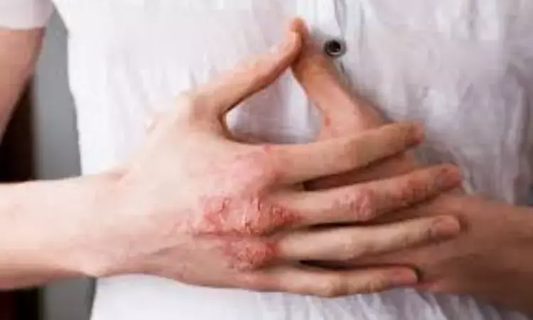 Suitable skin hygiene habits help reduce pruritus of hands and pain in individuals with hand eczema