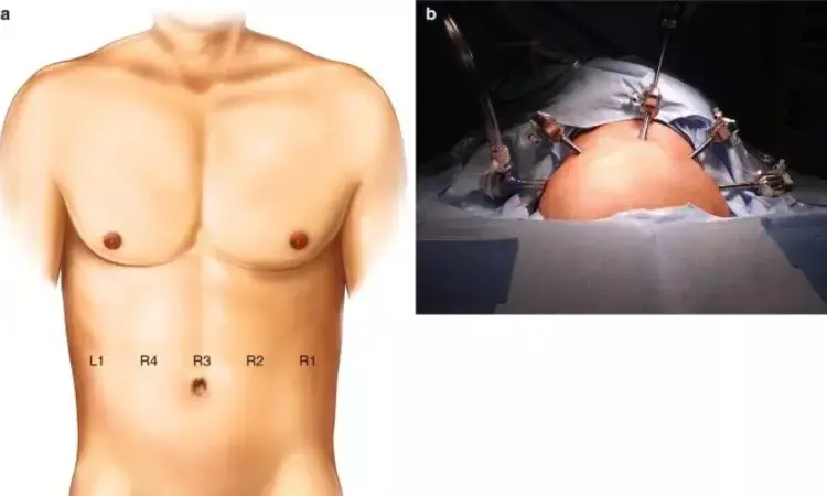 Laparoscopic ventral mesh rectopexy and transperineal mesh repair both effectively relieve constipation symptoms due to obstructed defecation syndrome