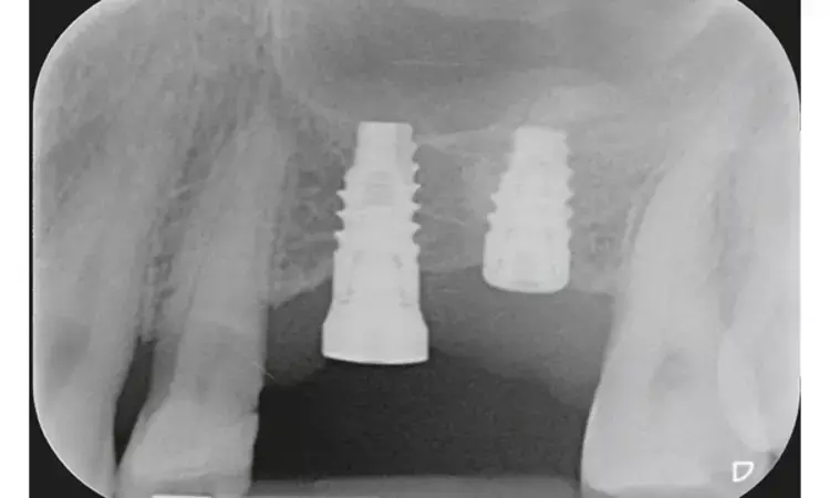 Placement of 6-mm implants as good as 11-mm implants for combined maxillary  sinus  floor augmentation