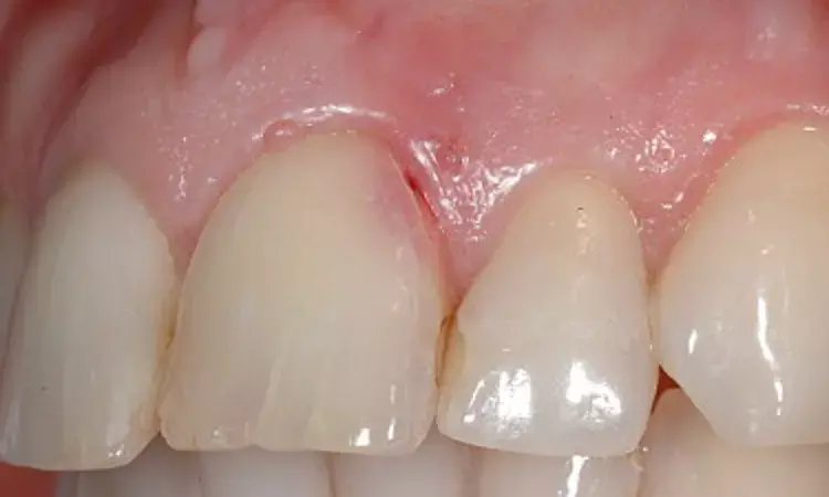 AI may help differentiate external cervical resorption lesions from caries lesions