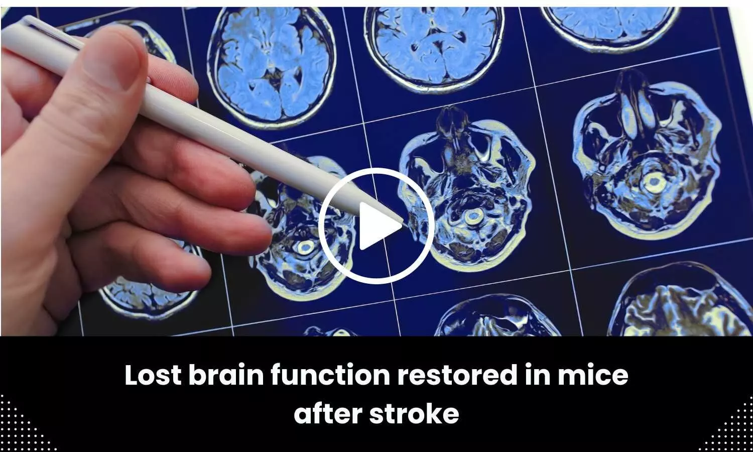 Lost brain function restored after stroke, finds study