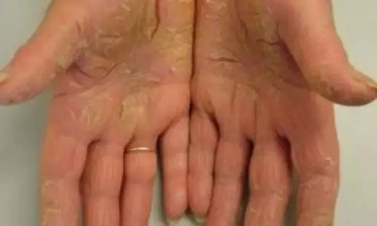 Bimekizumab effectively clears skin lesions in severe palmoplantar pustular psoriasis: JAMA
