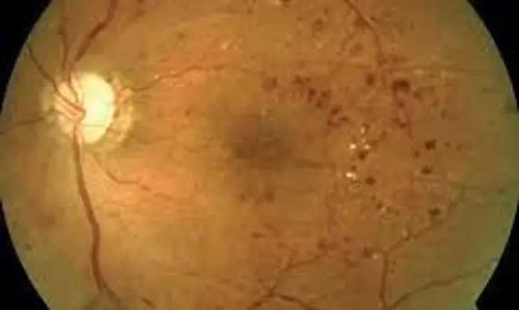 Omega-3 Fatty Acids fail to provide protection against retinopathy among diabetes patients