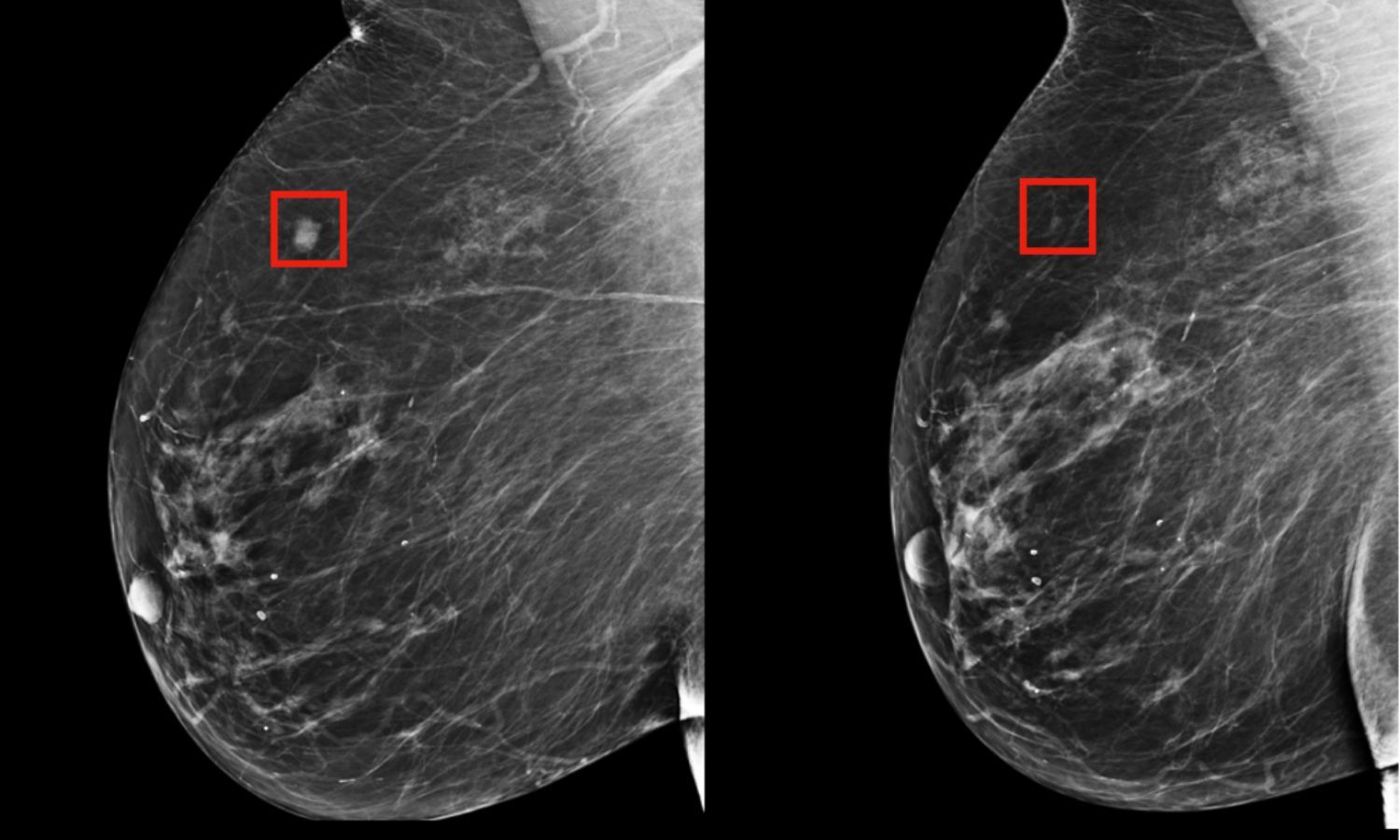 AI accurately predicts malignancy on breast ultrasound, cuts down ...