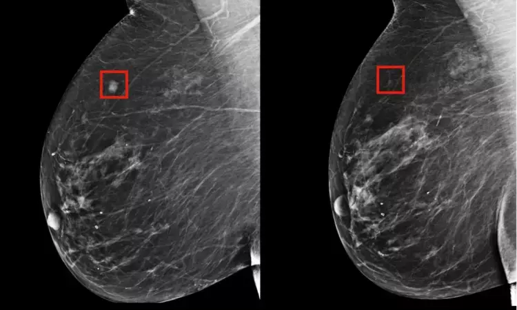 AI accurately predicts malignancy on breast ultrasound, cuts down excessive follow-ups and biopsies