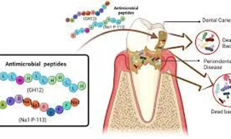 Adjunctive Antimicrobial peptide clinically effective for stage III grade B periodontitis