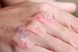 Topical emollient improves xerosis and QoL in atopic dermatitis