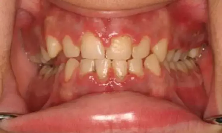 Diffuse gingival enlargement can be manifestation of hematological malignancies- Case report