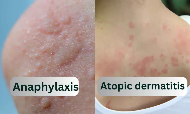 New guidelines released for treatment of anaphylaxis and atopic dermatitis