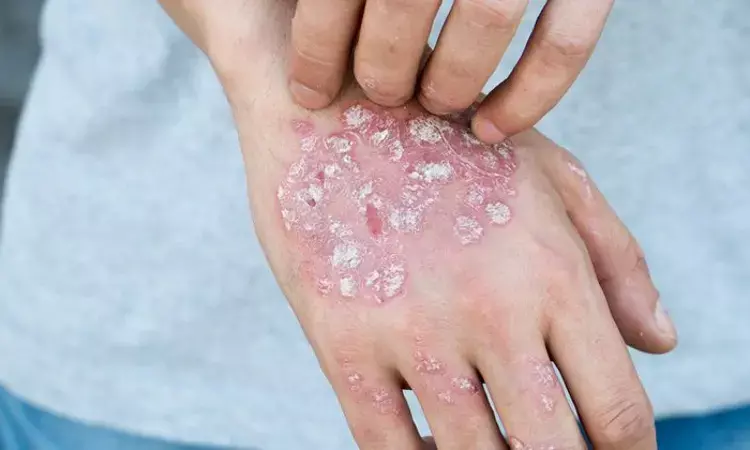 Guselkumab tied with early improvement in psoriasis associated arthritis