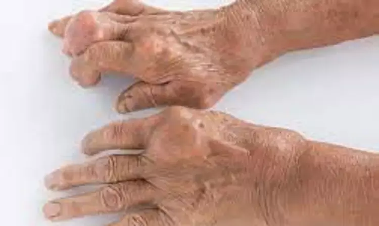 Hyperuricaemia associated with  higher prevalence of hand osteoarthritis