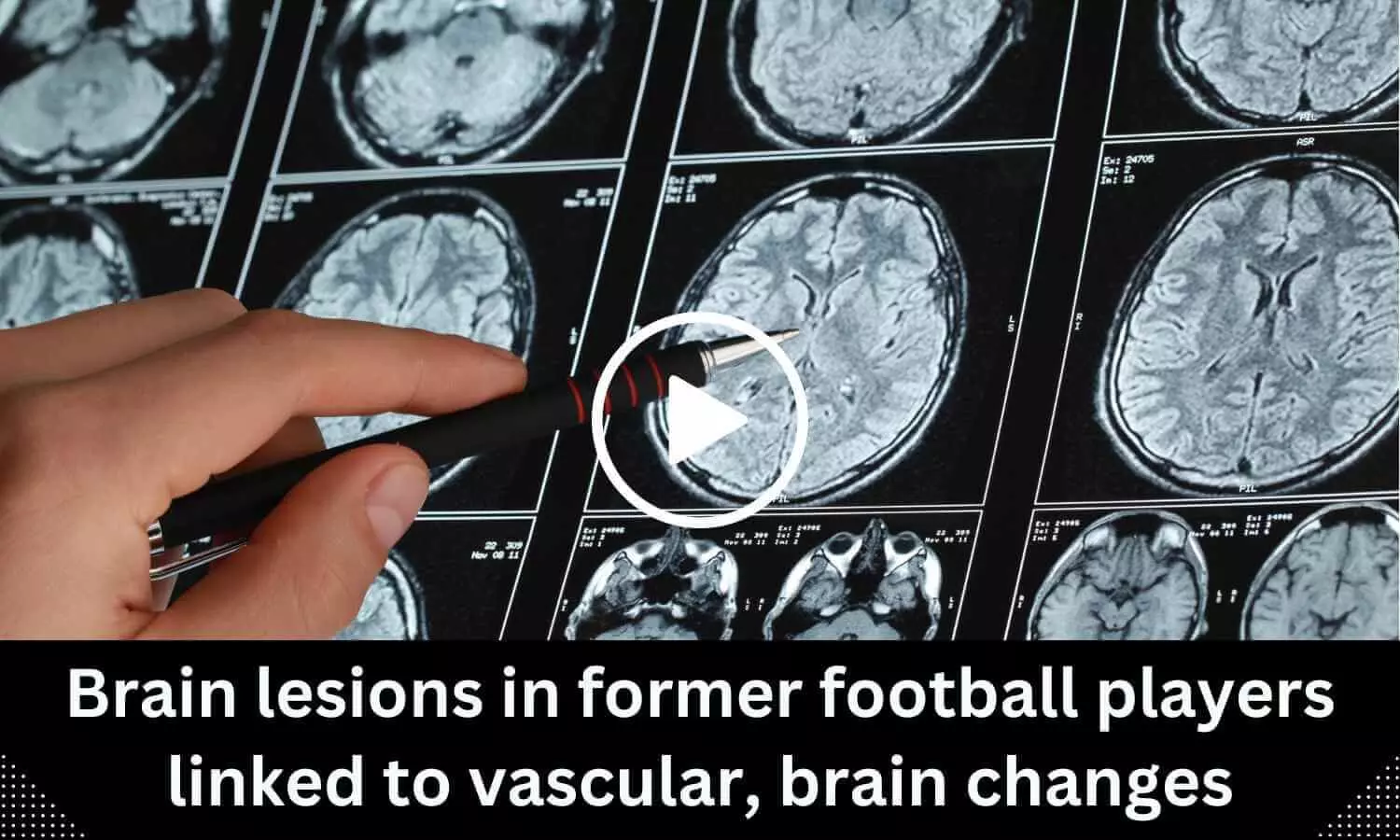 Brain lesions in former football players linked to vascular, brain changes