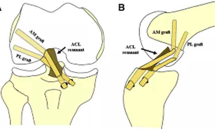 Two-stage ligament reconstruction effective to preserve function in knee dislocation,  claims study