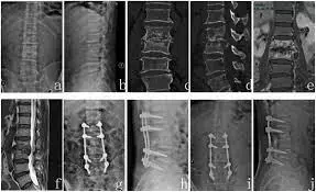 Both bone grafting and titanium mesh grafting equally  effective for treatment of spinal tuberculosis