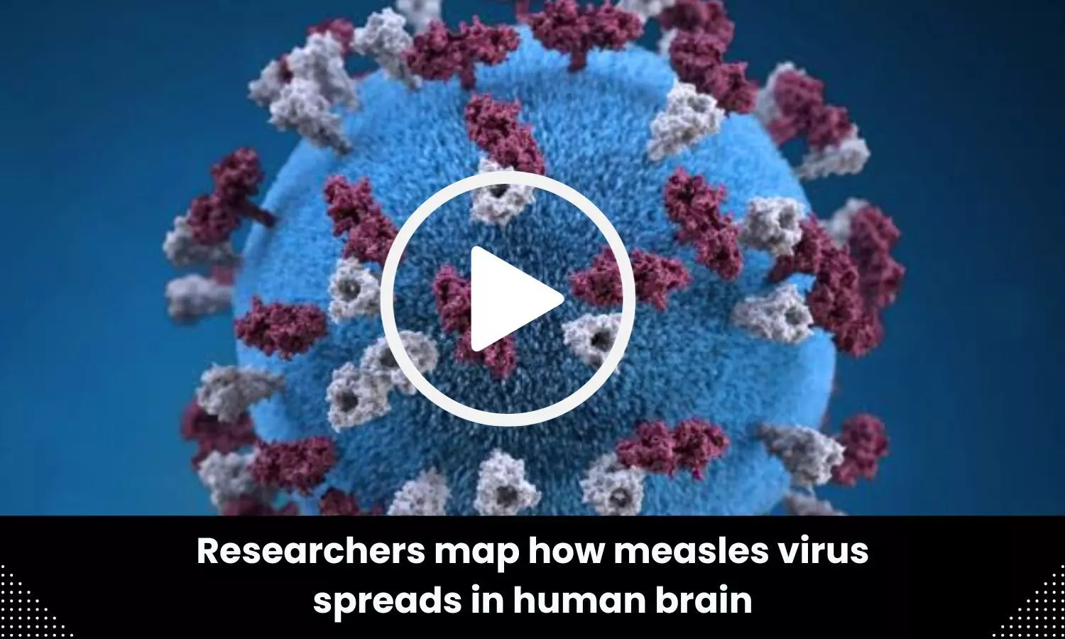 Researchers map how measles virus spreads in human brain