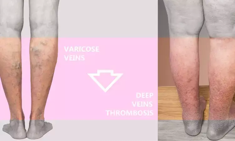 Graduated compression stockings demonstrate no additional benefit in preventing VTE