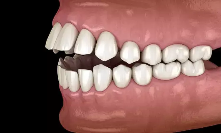 Clear aligners provide stable positive overbite in anterior open bite
