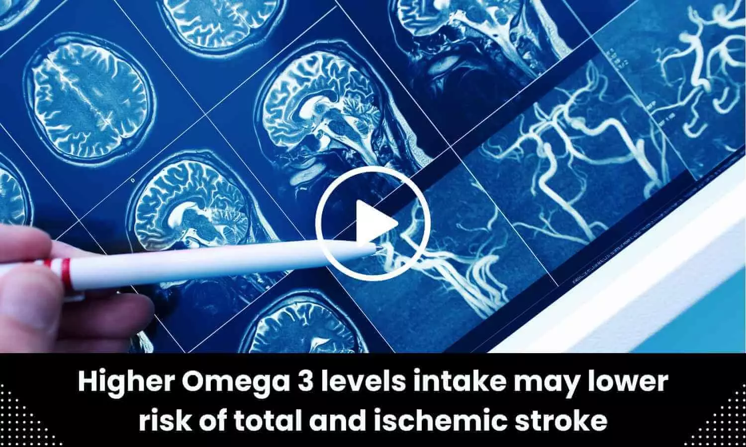 Higher Omega 3 levels intake may lower risk of total and ischemic stroke