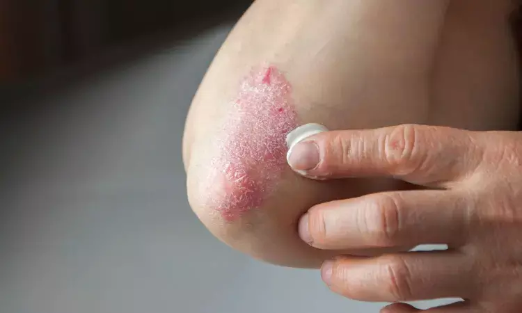 Systemic inflammation may play role in association between skin disease severity and CVD in psoriasis: JAMA