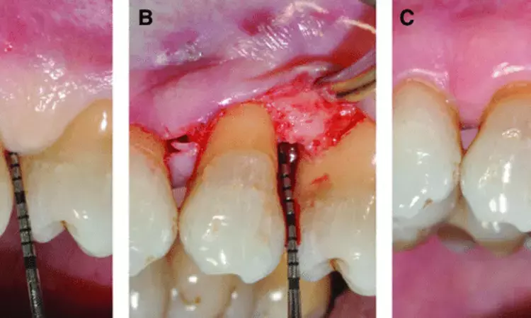 Residual Probing Depth and Periodontitis Grading Good Predictors of Tooth Loss Due to Periodontitis