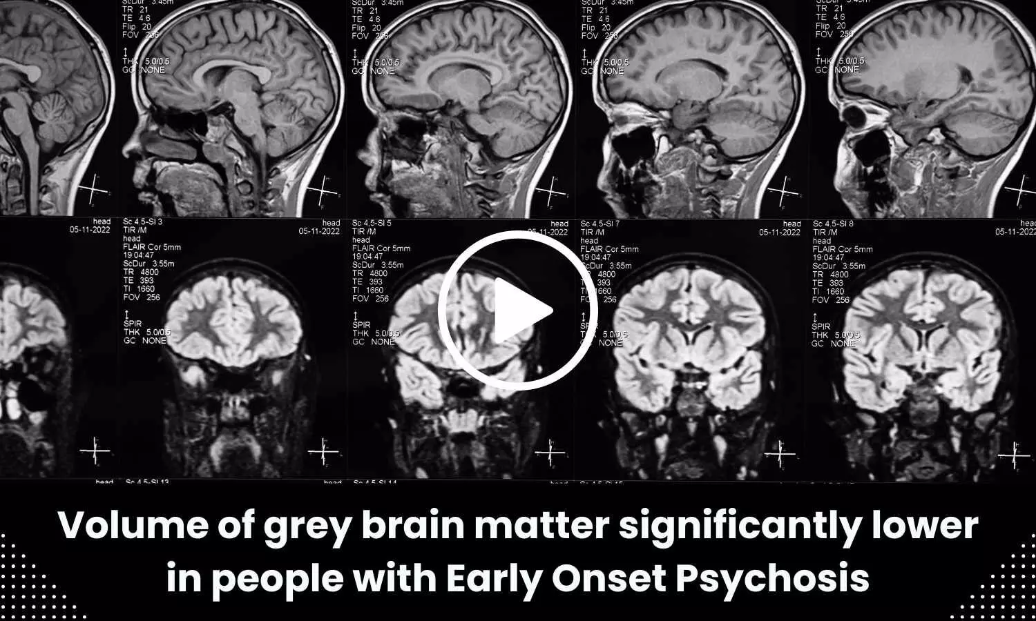 Volume of grey brain matter significantly lower in people with Early Onset Psychosis