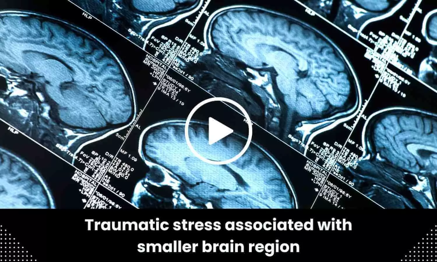 Traumatic stress associated with smaller brain region