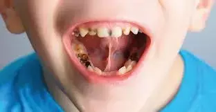 Oral or dental health problems frequently encountered in children with obesity, finds study