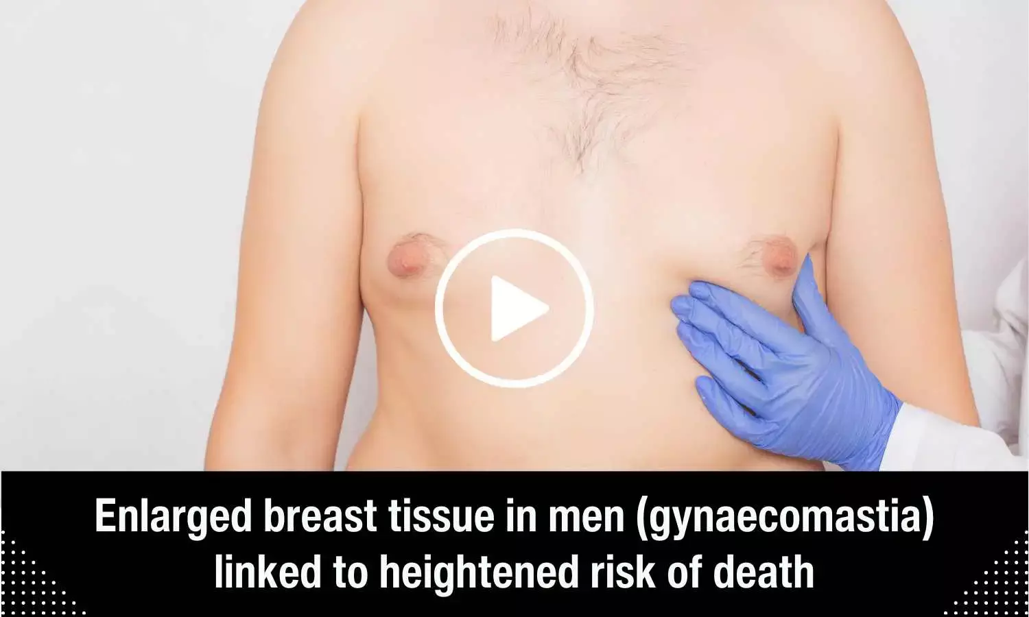 Enlarged breast tissue in men linked to heightened risk of death