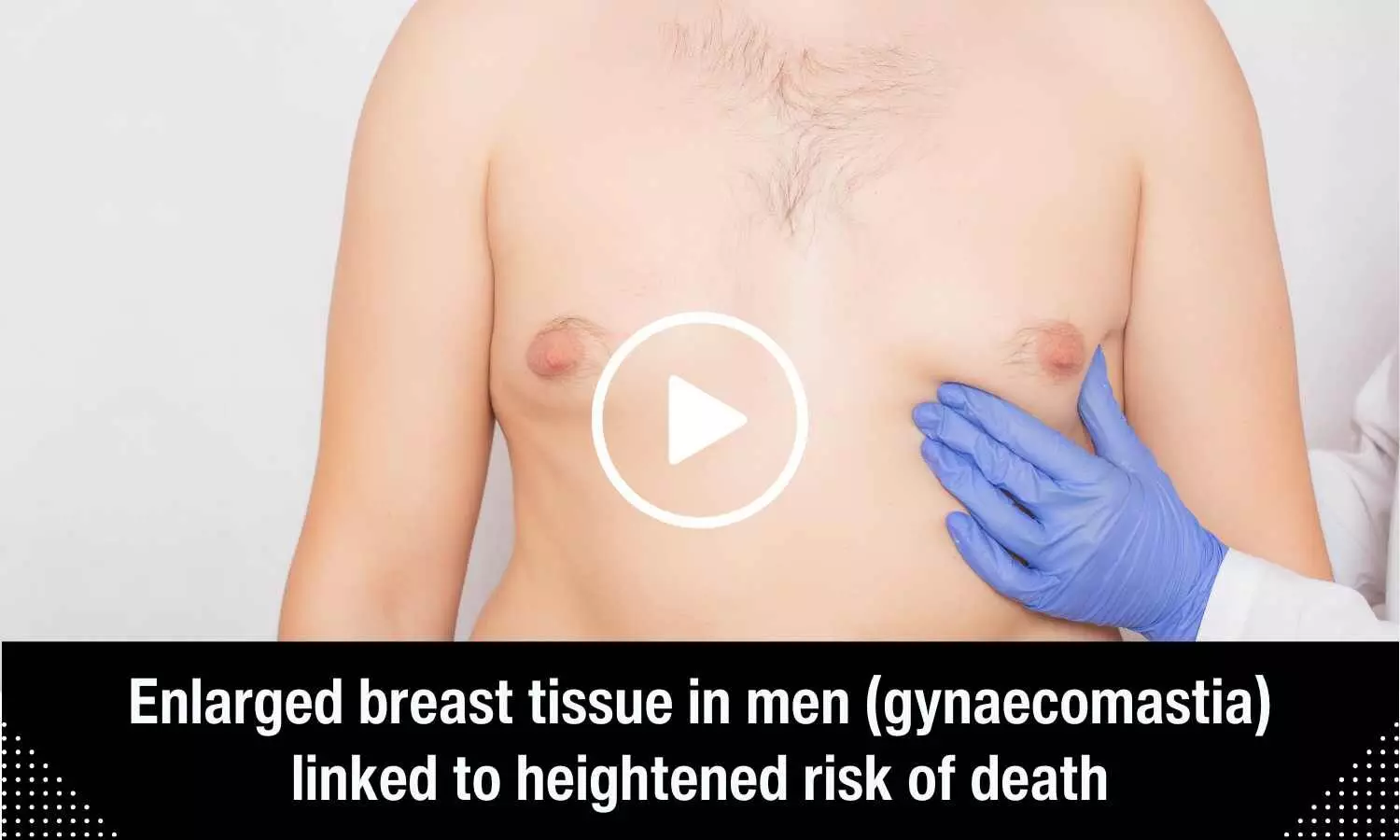 Enlarged breast tissue in men linked to heightened risk of death
